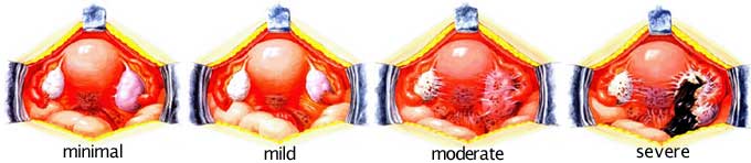 endometriosis