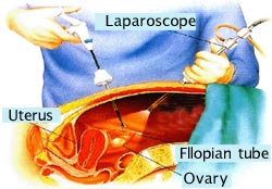 laparoscope