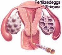 IVF