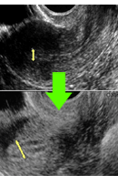 endometrium