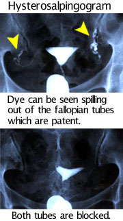 hysterosalpingogram