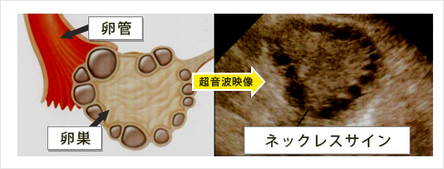 多嚢胞性卵巣 Pcoとpcos 卵巣過剰刺激症候群 セントマザー産婦人科医院