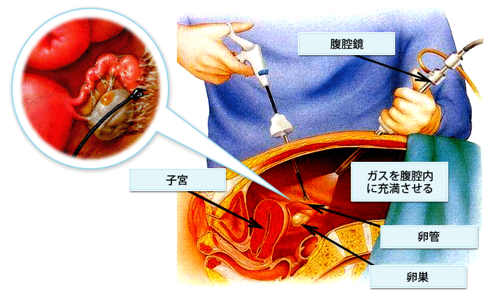 腹腔鏡検査