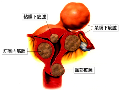 子宮筋腫