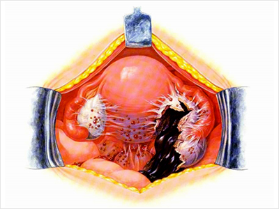嚢胞 チョコレート （2）卵巣チョコレート囊胞への対応