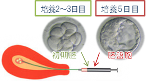 二段階移植法