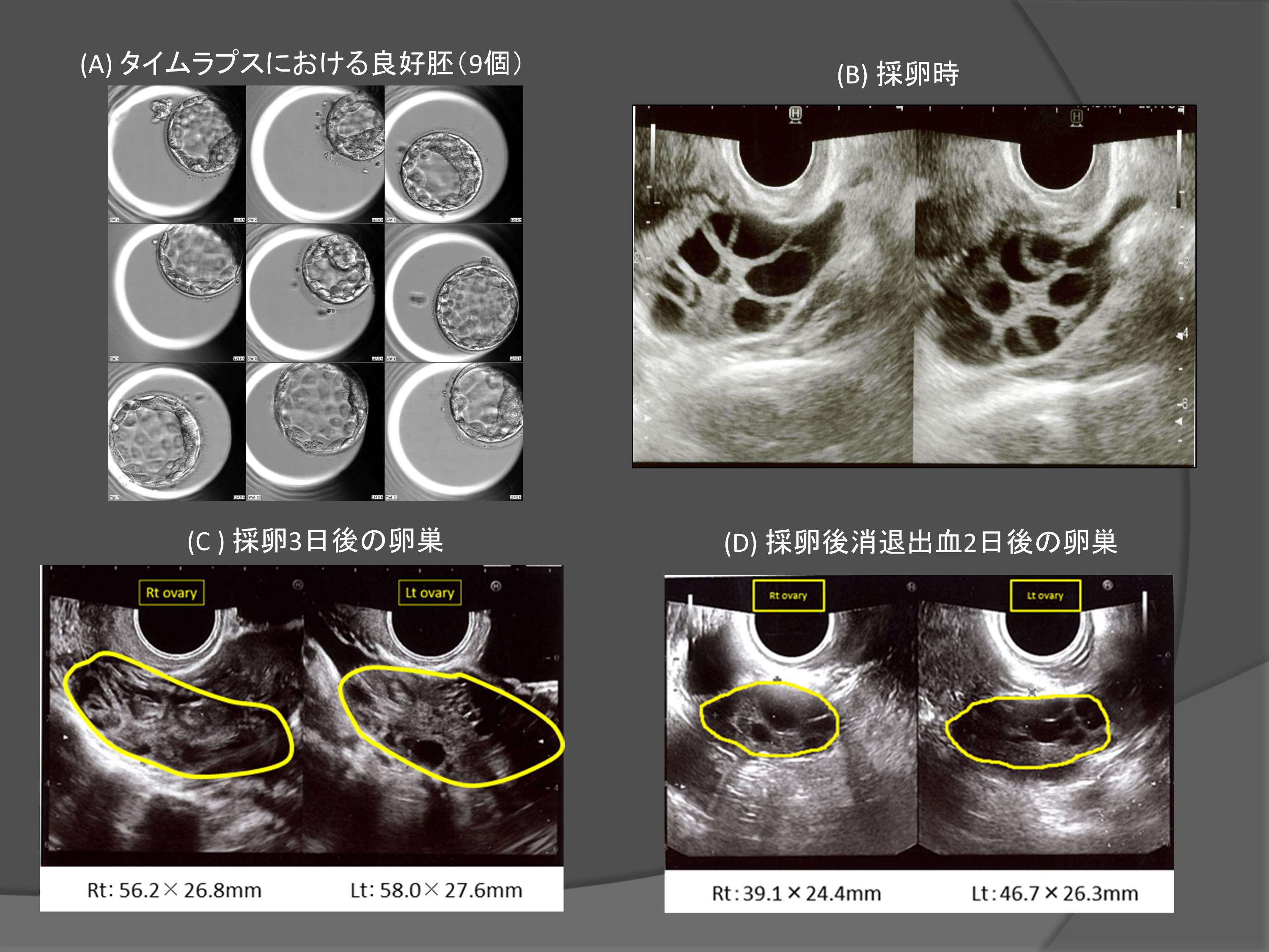 卵巣 嚢腫 妊娠 し にくい